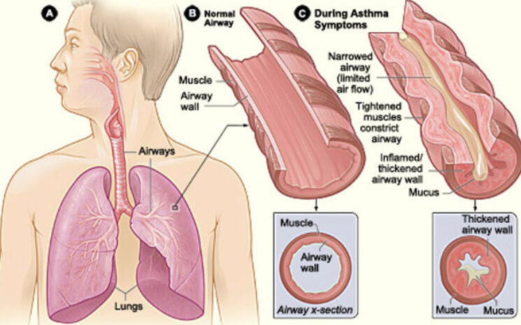 Diagram of normal airways compared to airways during asthma symptoms.
